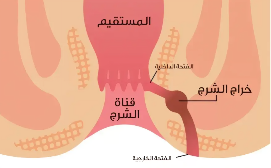 عملية الناسور الشرجي