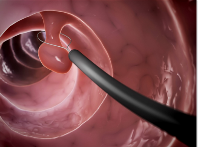 علاج اورام القولون في أسيوط